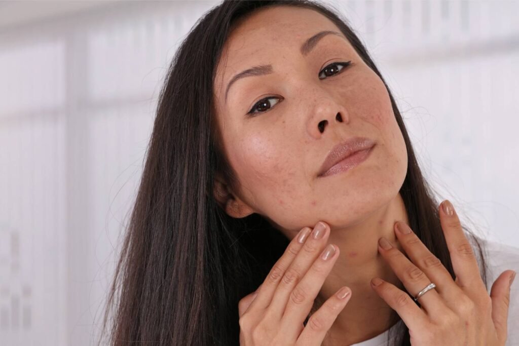 Acne Treatments in Athens, GA