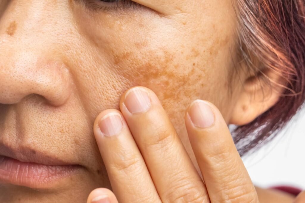 Pigmentation Treatments Athens, GA