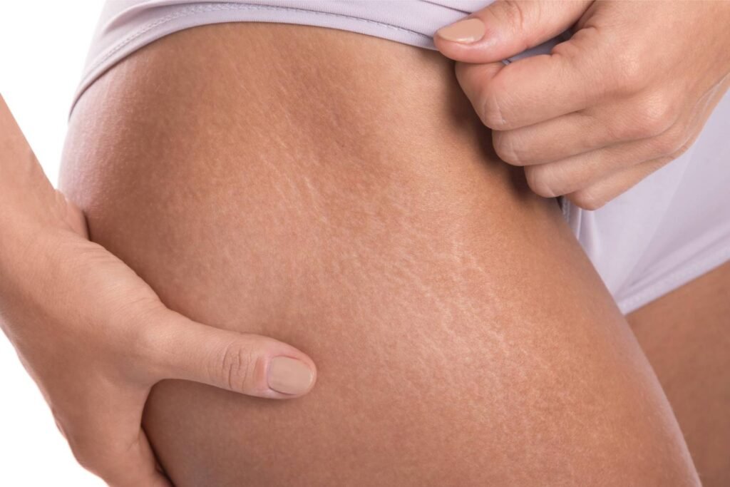 Stretch Mark Treatments Athens, GA